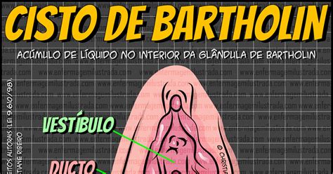 glândulas de bartholin e de skene|Cisto da glândula de skene: quadro clínico, diagnóstico e mais